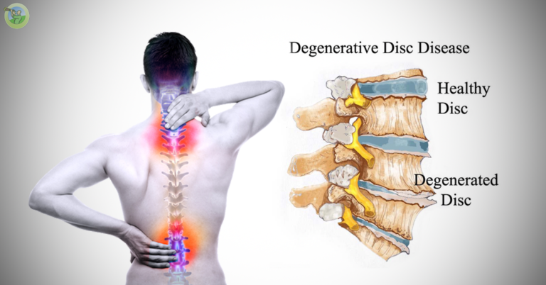 Degenerative Disc Disease: Causes, Symptoms & Treatment At ASAP Pain Management